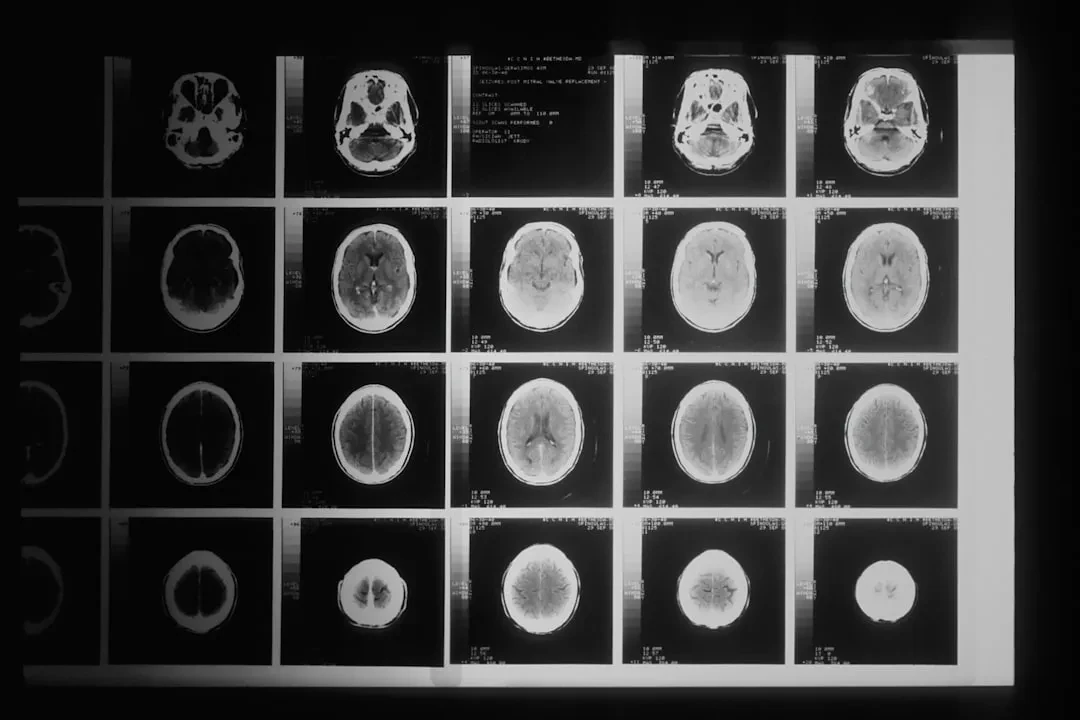Primo utente super di un impianto cerebrale per parlare e la mania sudcoreana per l'AI